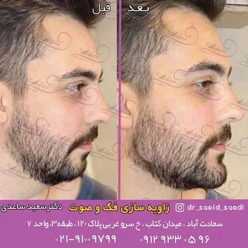 برای کانتورینگ صورت چند سی سی نیاز است
